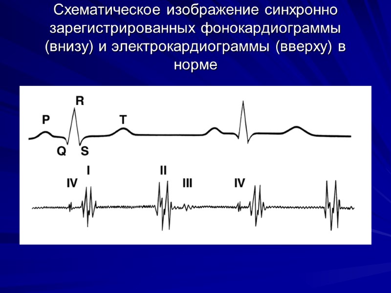 Схематическое изображение синхронно зарегистрированных фонокардиограммы (внизу) и электрокардиограммы (вверху) в норме Схематическое изображение синхронно зарегистрированных фонокардиограммы (внизу) и электрокардиограммы (вверху) в норме